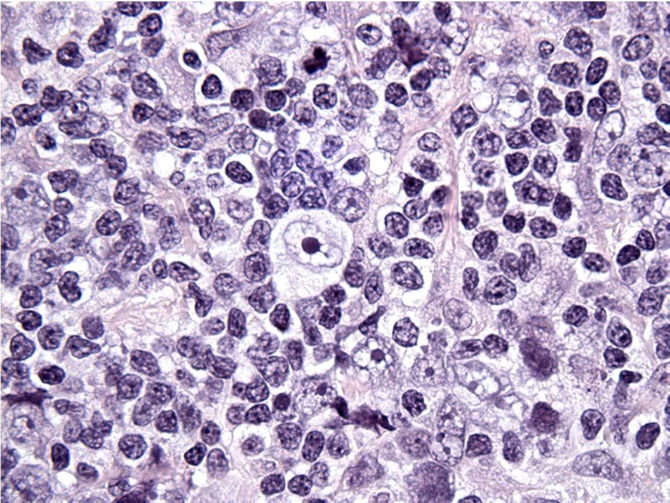Quantifying Anti-Tumor Immunity Example: Classical Hodgkin Lymphoma (CHL) Aggressive lymphoma of B-cell lineage with unique morphology, microenvironment, and phenotype 20-30% associated with EBV