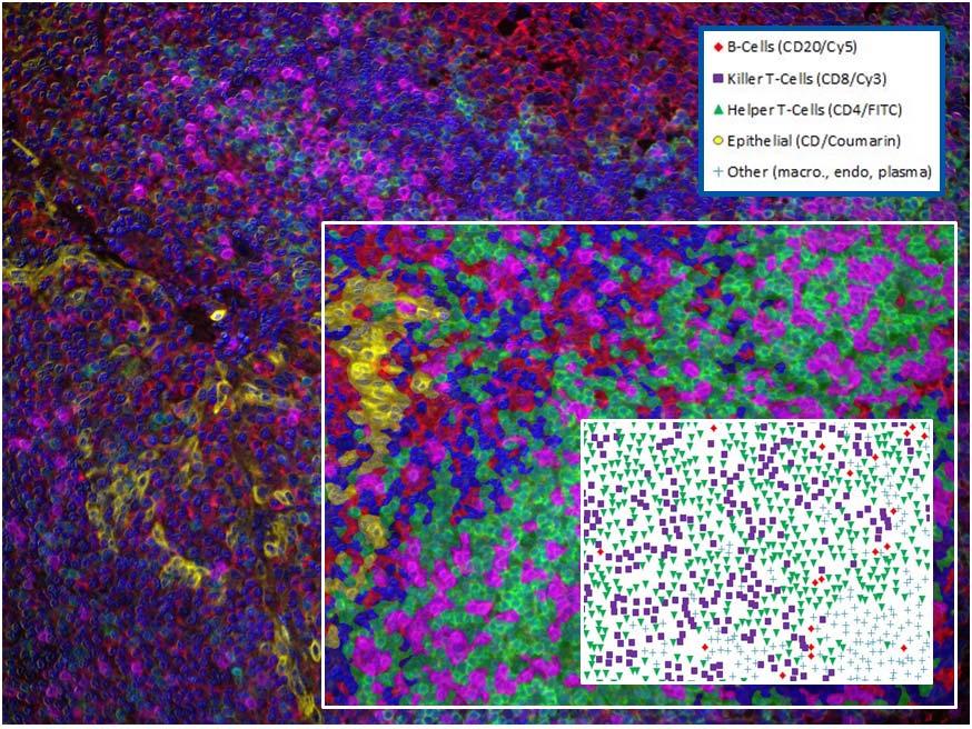 Case Study TIL s in Breast Cancer Immunological correlates in Breast Cancer Assay initially optimized in human tonsil proof of concept (A) Unmixed composite of a multispectral image.