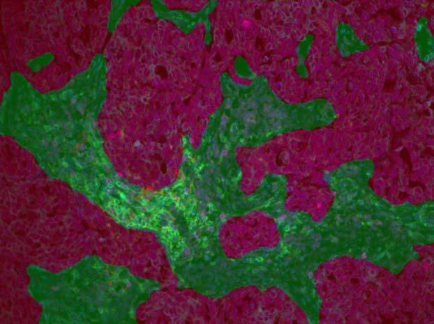 With inform pattern recognition of tumor (red) and stroma (green). C.