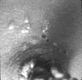 recurrence; attack rate about 50% Clues: skin vesicles in 70%, fever, seizures, pneumonia, DIC, conjunctivitis Diagnosis: