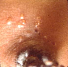 Neonatal HSV-2 Neonatal HSV Infection, 1600 cases annually Skin, eye, mucous membrane (40%) Skin vesicles Good prognosis with early treatment Untreated 75% develop disseminated infection CNS