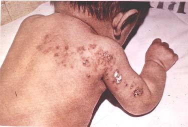 Zoster in a 3 month old VZV In the Immunocompromised Varicella is likely to be severe Prevent or modify with pre-formed antibodies just after exposure Virus spreads from cell-cell in body requires