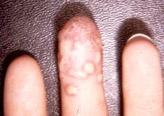 Herpetic whitlow, HSV 1 HSV causes about 1000 cases of encephalitis annually in USA Most common form of focal encephalitis in USA Primary or recurrent HSV-1 ; skin lesions may be present (not helpful