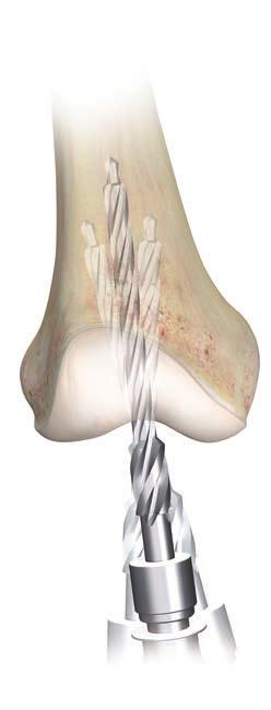 The drill may be positioned anteromedially to allow unobstructed passage of the I.M. rod in the femoral canal (Figure 14). Isthmus level Attach the T-handle to the I.M. rod and slowly introduce the rod into the medullary canal, to the level of the isthmus (Figure 15).