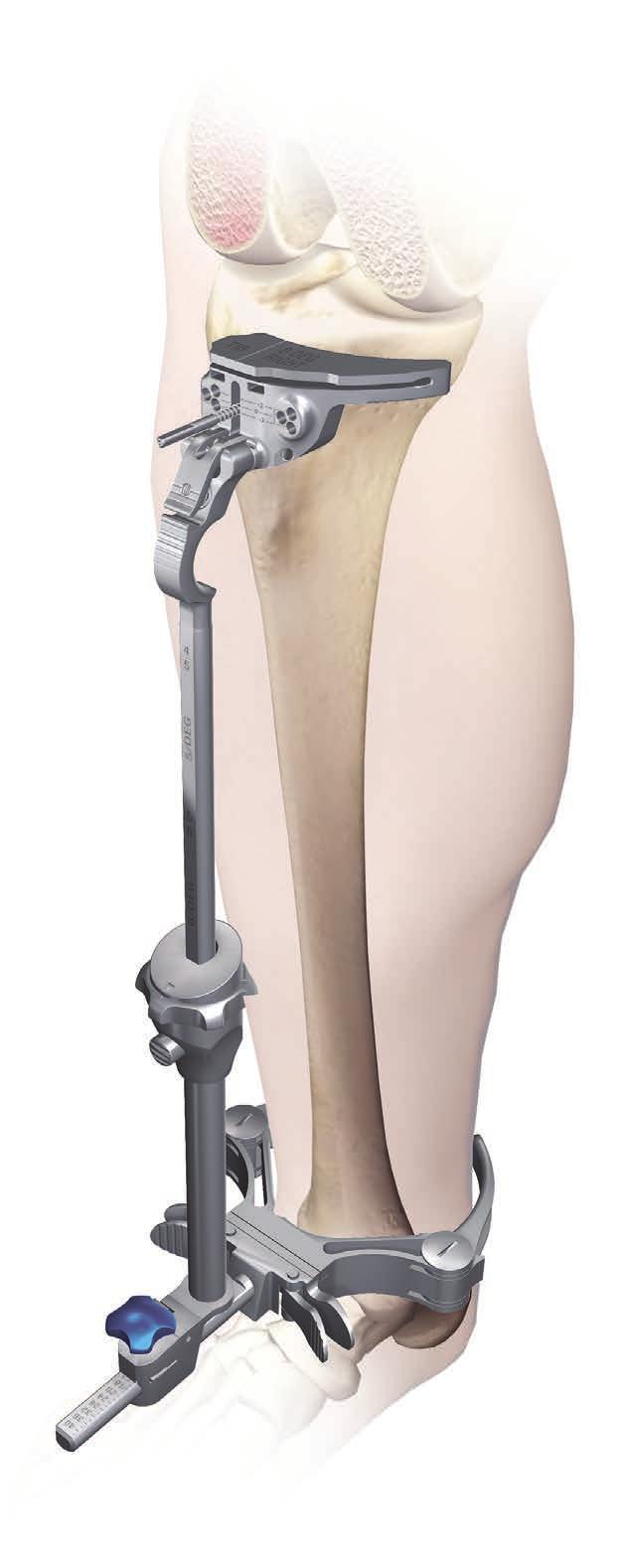 Lower Leg Alignment Place the knee in 90 degrees of flexion with the tibia translated anteriorly and stabilised. Place the ankle clamp proximal to the malleoli (Figure 25).