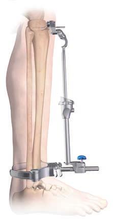 Slope The tibial jig uprod and ankle clamp are designed to prevent an adverse anterior slope.