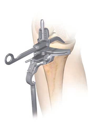 Height When measuring from the less damaged side of the tibial plateau set the stylus to 8 mm or 10 mm.