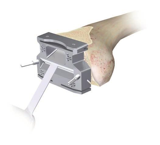Place retractors to protect the medial cruciate ligament medially and the popliteal