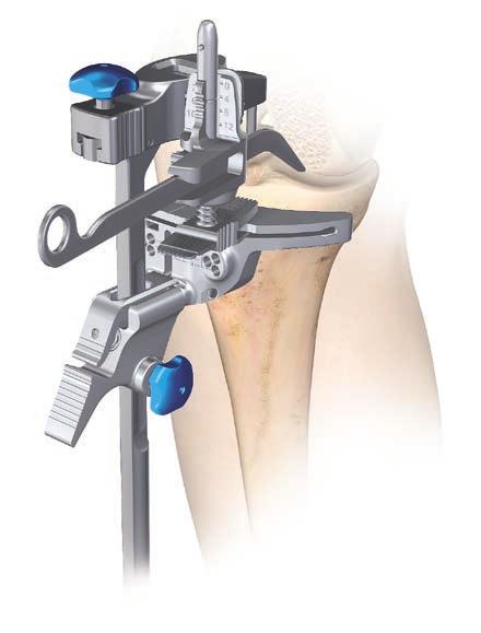 Non-slotted stylus foot Height Loosen the proximal/distal sliding knob, insert the adjustable tibial stylus into the cutting block, and adjust to the correct level of resection.