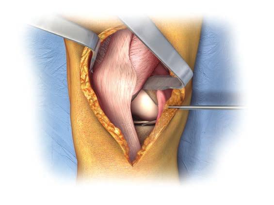 Two 90 degree bent-hohmann retractors are very useful for this procedure and are highly recommended (Figure 5).