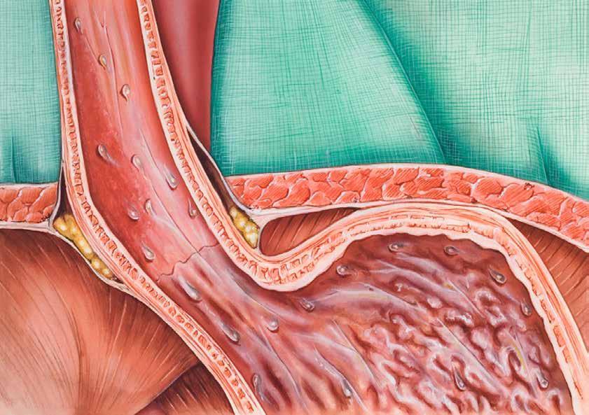 Gastroesophageal reflux disease (GERD), caused when the lower esophageal sphincter (LES) does not close properly, and stomach contents leak back (reflux) into the esophagus.