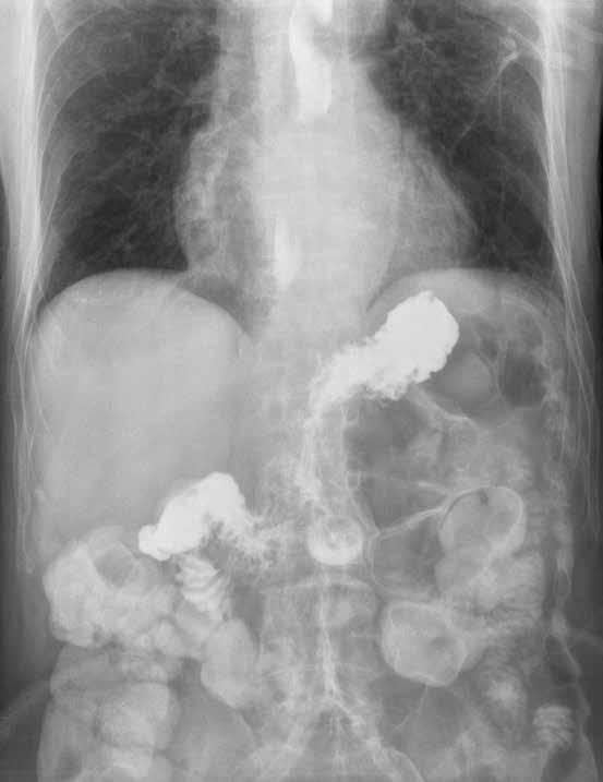 X-ray of the abdomen and chest in a patient with a gastrostomy.
