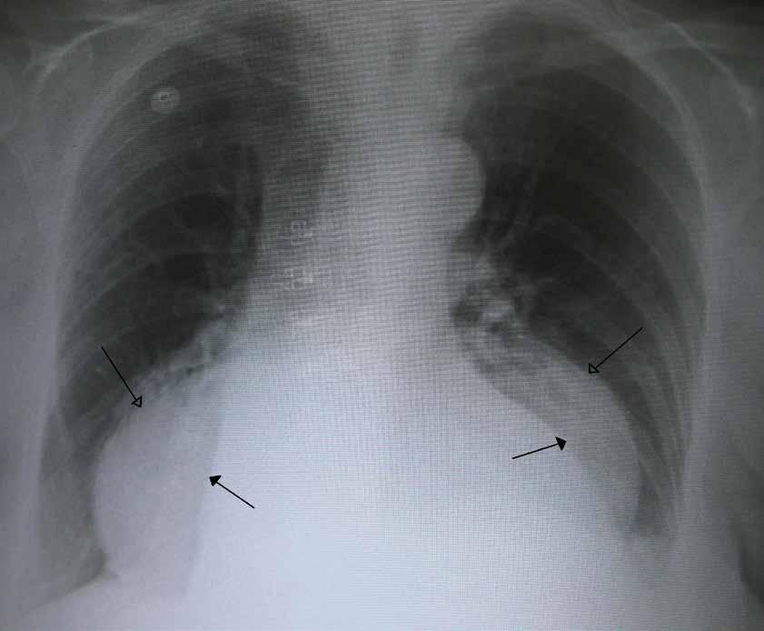 A large hiatal hernia on an X-ray marked by open arrows in contrast to the heart borders marked by closed arrows.