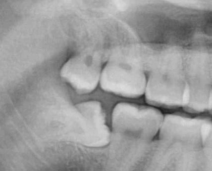 The Wise Guide to Wisdom Teeth Extraction H. Ryan Kazemi, DMD 11 Types of Wisdom Teeth Positions Erupted: The tooth has completely emerged through the gum tissue and is visible.