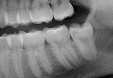 Soft tissue impaction: The tooth is somewhat erupted beyond the bone, but is still covered partially or completely with gum tissue.