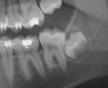 The Wise Guide to Wisdom Teeth Extraction H. Ryan Kazemi, DMD 12 Full bony-impaction: The tooth is completely stuck in the jaw bone and has not emerged beyond the bone level.