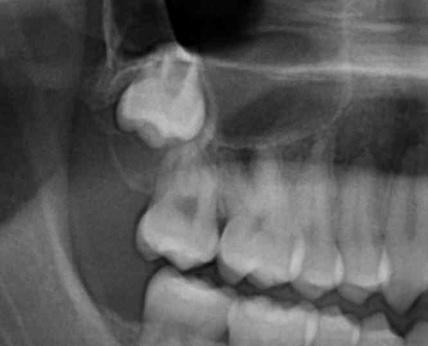 Patients ages 15 to 21 typically have full bony-impacted wisdom teeth, mostly because there isn t enough space in the mouth.