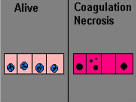 Coagulative necrosis Cells have died but the basic shape and architecture of the tissue endures Most common manifestation of ischaemic necrosis in tissues.