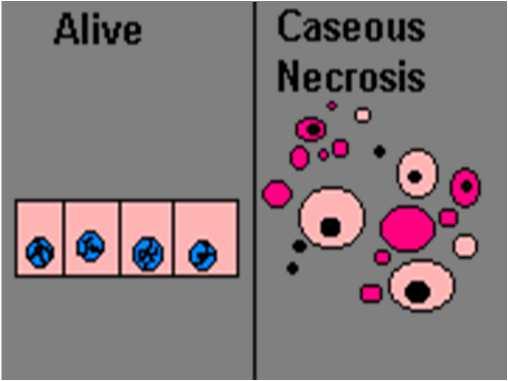 Caseous necrosis Accumulation of amorphous (no structure) debris within an area of necrosis.