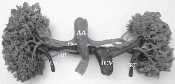B. Saldarriaga et al., Renal arteries variations Figure 1.