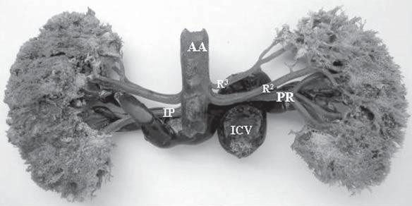Bilateral additional renal arteries; AA abdominal aorta; ICV inferior cava vein; LRV left renal vein; IP inferior polar; PR main renal artery. Figure 2.