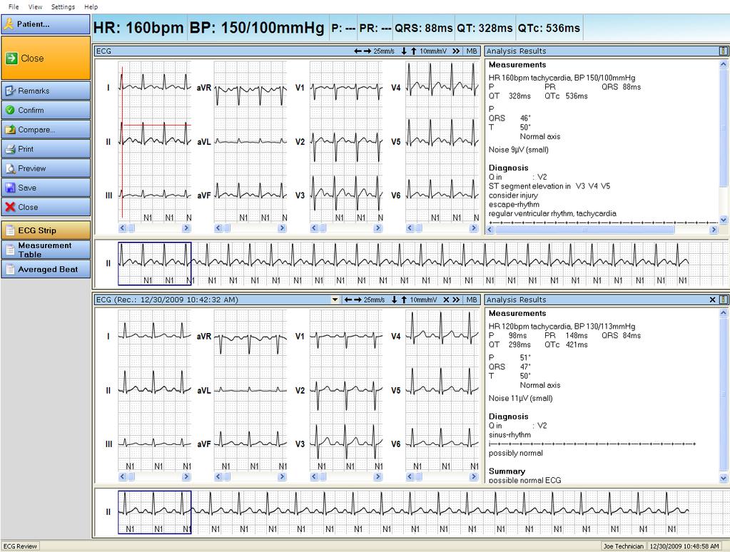 Displaying an ECG record Opening a record for comparison You can compare multiple ECG records. To compare records: 1. Open a record. 2. Click Compare... or select View Compare.