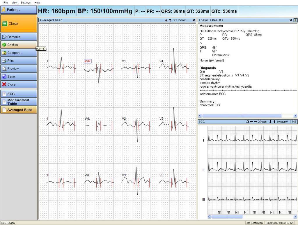 Displaying a Resting ECG Record Averaged beat view As with the ECG view, the Averaged Beat can display as a maximized view. To change the views see Controls for changing the view on page 8-5.