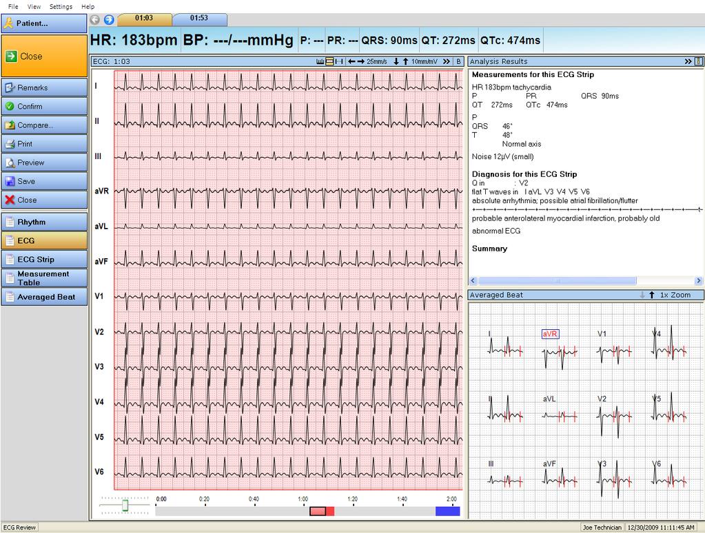 Displaying a Rhythm ECG record Rhythm ECG window The title bar of the program displays the test procedure, the recording date and time as well as the patient's data.