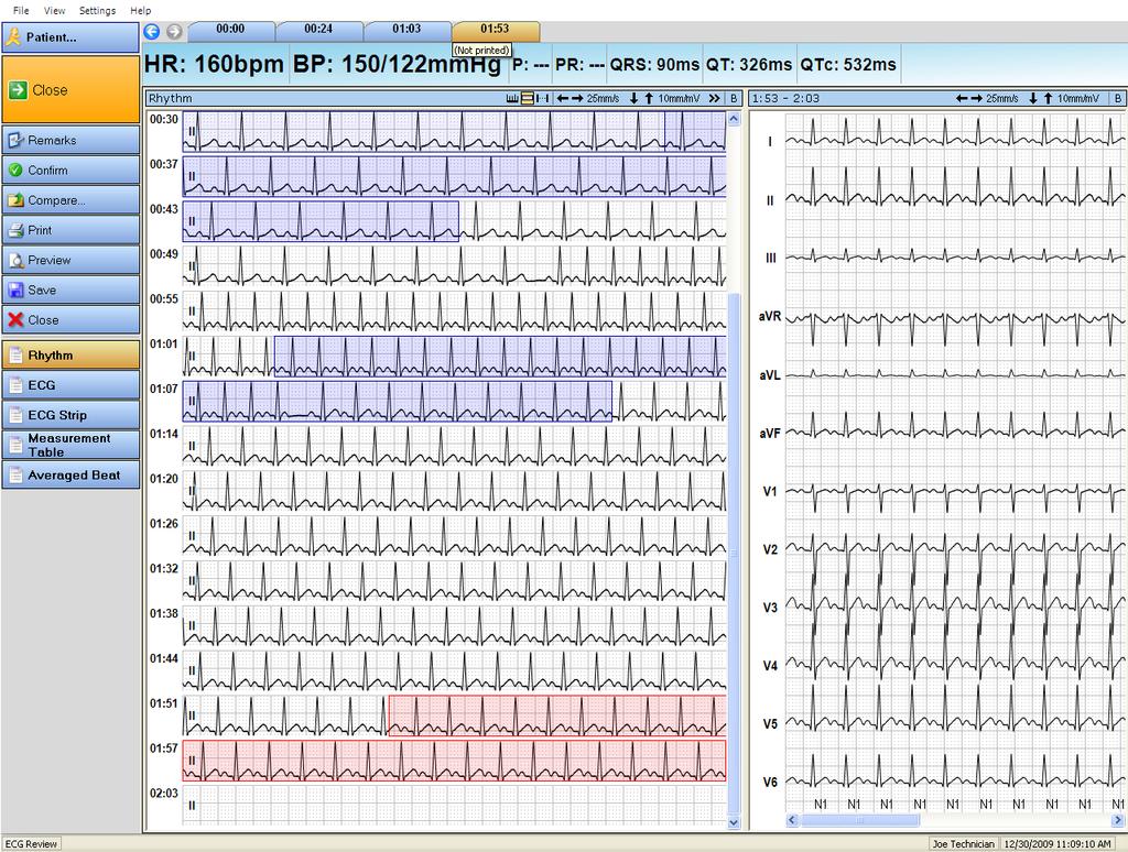 Displaying a Rhythm ECG Record Rhythm view The Rhythm view shows the rhythm strips in the main display. The beginning times of every ECG line are indicated to the left of the rhythm strip.