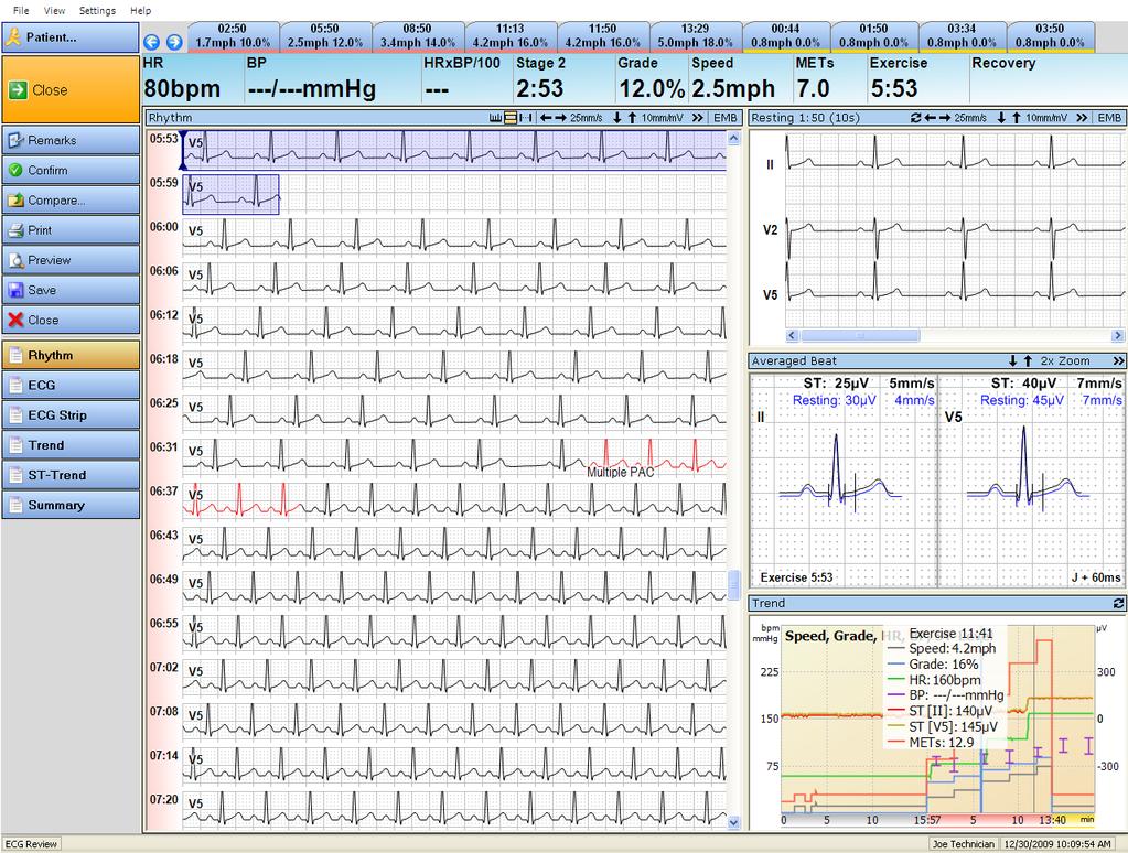 Display a Stress Test ECG Record Rhythm View The rhythm view shows the rhythm strips in a multi-panel window.