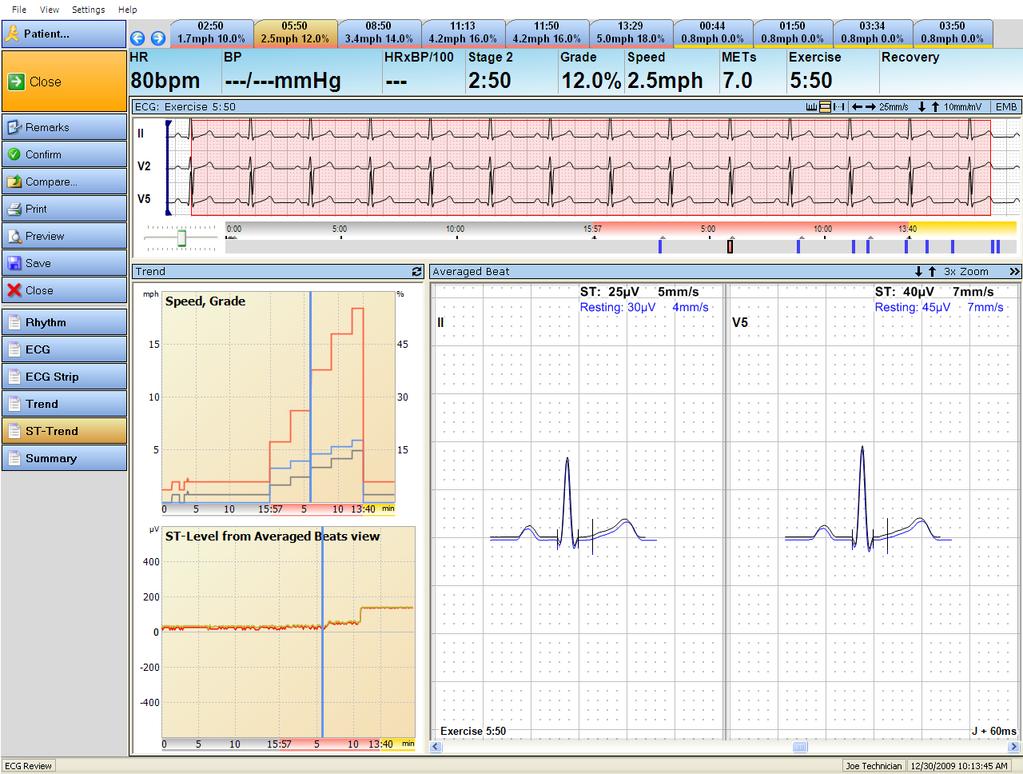 ST Trend view ST Trend view ECG windows and trend chart are synchronized. The use of the tabs and the multichannel ECG corresponds to the Trend panel on page 10-14.