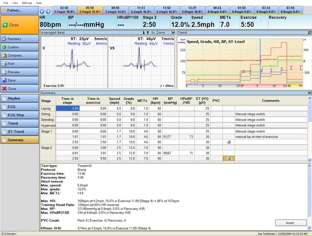 Summary view Summary view The Summary view shows a multi-panel window consisting of: result table summary of the most significant exercise data ECG strip,