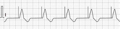 Pacemaker detection Pacemaker detection The settings for pacemaker detection can be changed during the ECG acquisition. To change pacemaker detection: 1. Open Settings Pacemaker detection... 2.