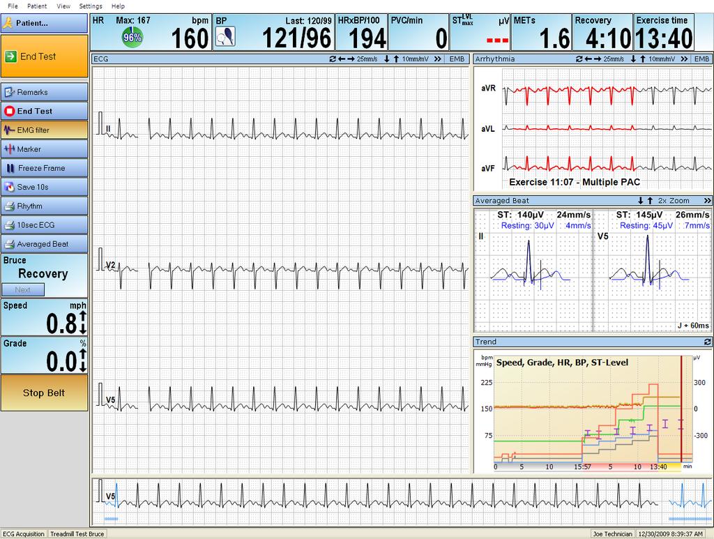 Acquire a Stress Test ECG Stress test displays This section describes the stress test displays. Stress test window The stress test displays in a multi-panel window.
