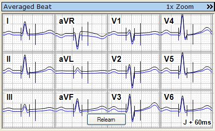 Stress test displays 3*4 Configuration Options Configure the basic settings of the Averaged Beat representation Change the measuring units of the ECG Amplitude 1.