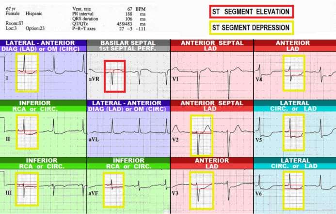 F LEAD avr sometimes referred to as the forgotten 12 th lead can be a source of valuable information. In this case study, lead avr is the only lead with ST elevation.