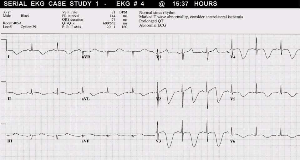 APPROX 9 hrs AFTER 1 ST ECG:
