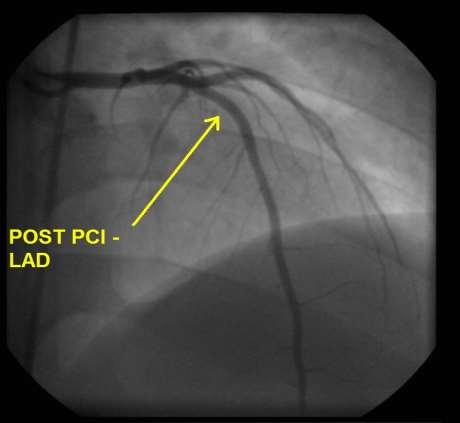 A.D. BOTTOM RIGHT: POST STENT