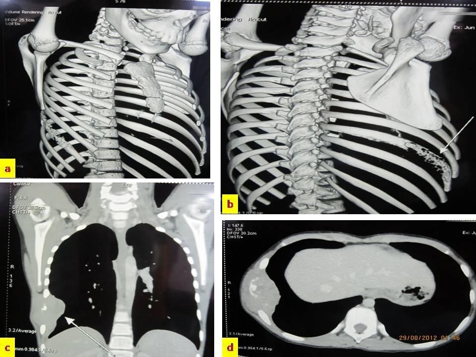 Indian Journal of Medical s ISSN: 2319 3832(Online) Figure 2: (a) & (b) shows 3D reconstructed view of chest showing destruction of