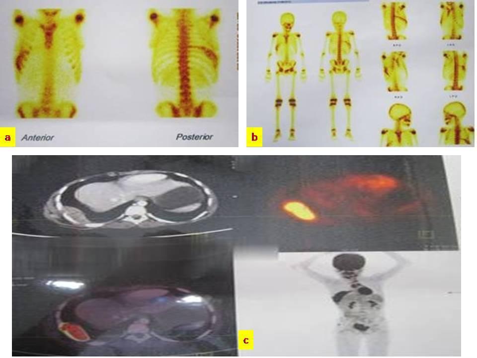 Indian Journal of Medical s ISSN: 2319 3832(Online) Figure 4: (a) & (b) whole body scan images showed increased uptake in the right chest wall 8 th rib alone.