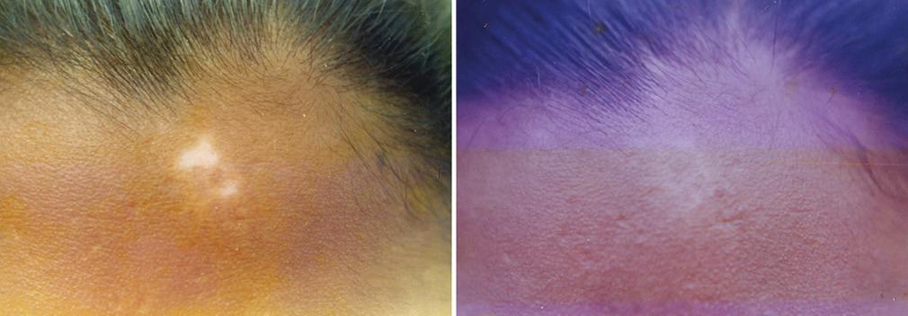 Type of vitiligo Site of vitiligo 10 20 21 30 31 40 >41 M F S F M AF Non glrous Glrous Mucosl lip Excellent (91 100) 100% Good (71 90) 83% 71% 67% 80% 71% 80% Fir (51 70) 67% 57% 56% Bd<50 17% 15%
