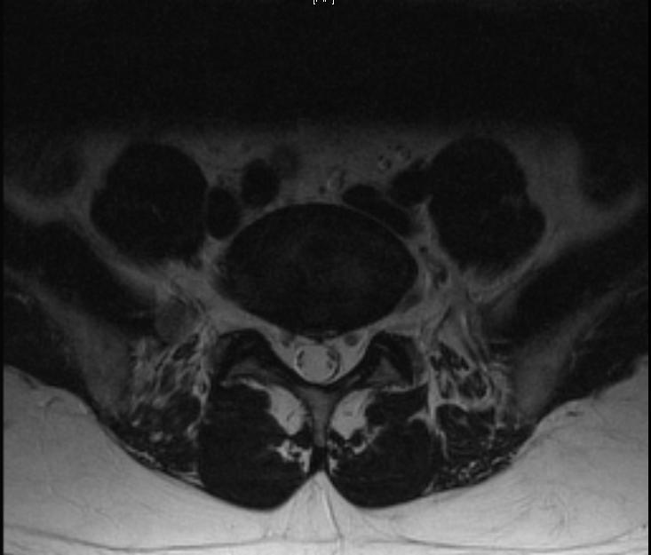 weighted image Axial T2