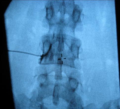 Neuromodulation(spinal cord