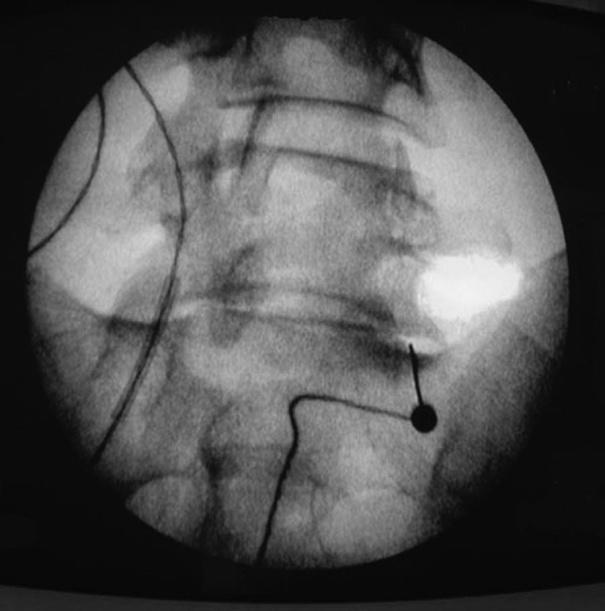 Facet joint injection in low-back pain. A prospective statistical study, Spine. 1988 Sep;13(9):966-71.