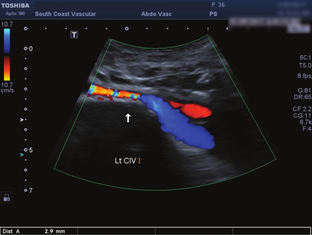 A Figure 3. Venogram showing compression of left CIV and corresponding duplex ultrasound with measurements. B Figure 2.