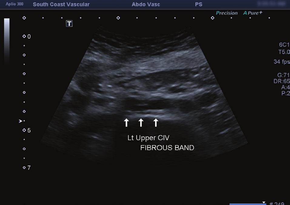 Figure 4. Duplex ultrasound image showing intraluminal irregularities.