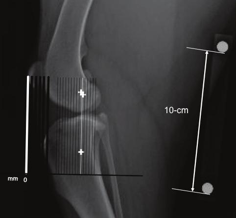 STEP 4 Align the Template with the Attachment Point of the Patella Ligament to the Patella: K K Take the line template and set the top of the 0 line (shown in white for clarity) at the insertion