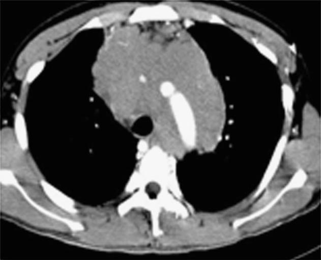 Computed tomography showed a soft-tissue mass with oval shape in the upper anterior mediastinum that had an even density as well as superior vena cava and pulmonary trunk (filling defect) oppression