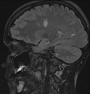 (inferior edge of CC) Middle cerebellar peduncle Brainstem DDx Acute