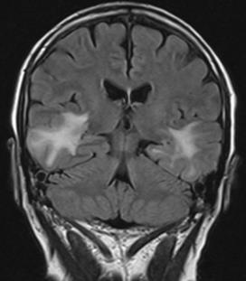 dementia After extensive workup, initially diagnosed with limbic encephalitis Symptoms and imaging worsened so biopsy performed Pathology: